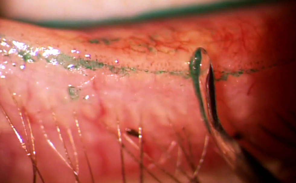 lid debridement image 3