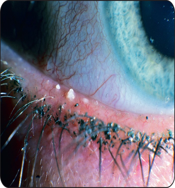 meibographyresize 3 300x234 1