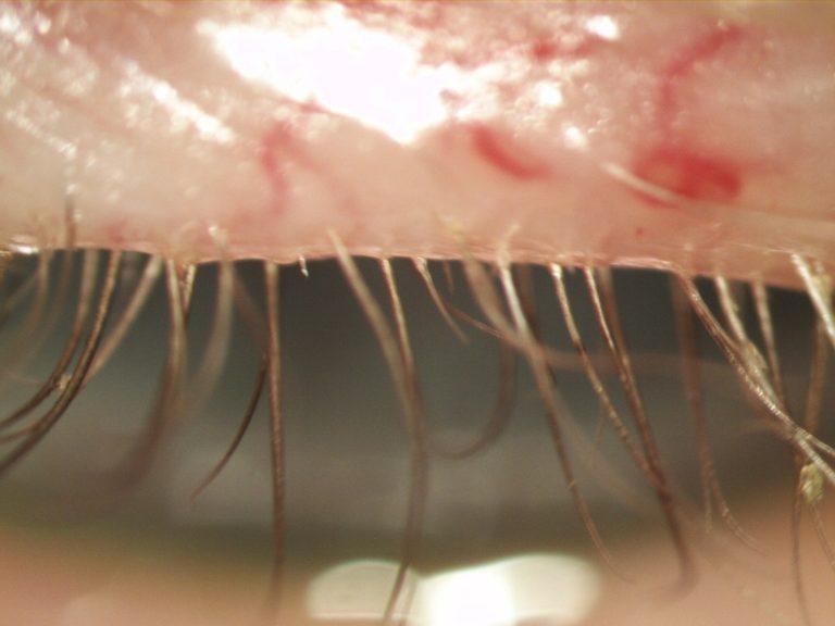 same eyelid after blepharitis treatment 768x576