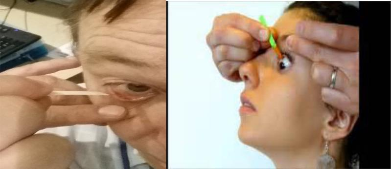 If you still place Fluorescein like this